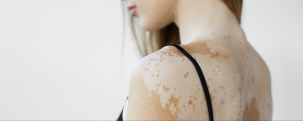 Recomendações de especialistas sobre o uso de terapêutica tópica para vitiligo em pacientes pediátricos, adolescentes e adultos jovens